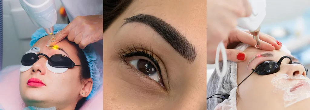 Microbladed Eyebrow Laser Removal