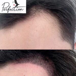 hairline microblading