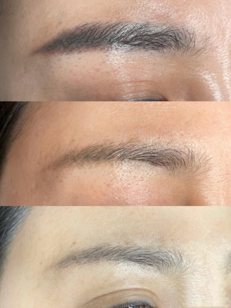 permanent makeup removal