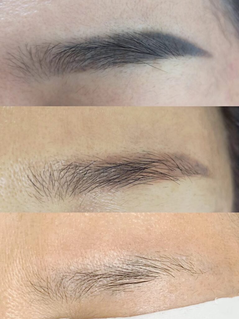 permanent makeup removal