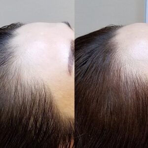hairline microblading