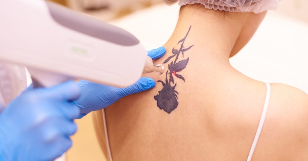 Two gloved hands using a tattoo removal laser machine to work on a tattoo of a flower on the back of a woman's neck.
