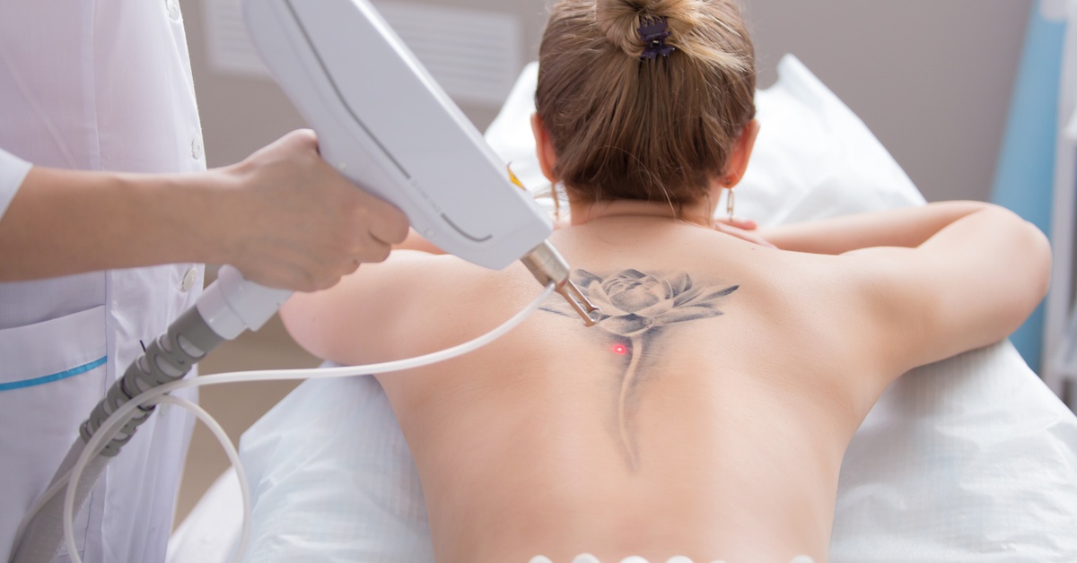 A doctor using a large laser gun to remove a flower tattoo from a female patient's back who is lying on a bed.
